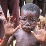 Monkey Pox: Osun Govt. Set Up Quarantine Centres